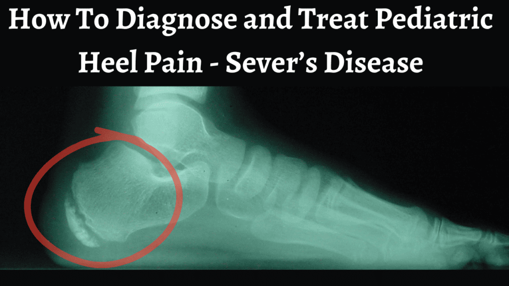 Sever's Disease of the Heel